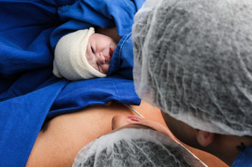 Baby liegt direkt nach der Kaiserschnittgeburt auf Mutter